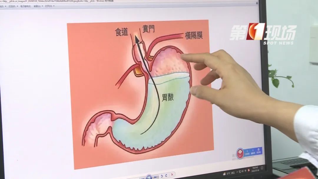 吃泡面竟引发消化道出血!这类人群高发,尤其夏天 吃泡面竟引发消化道出血!这类人群高发,尤其夏天