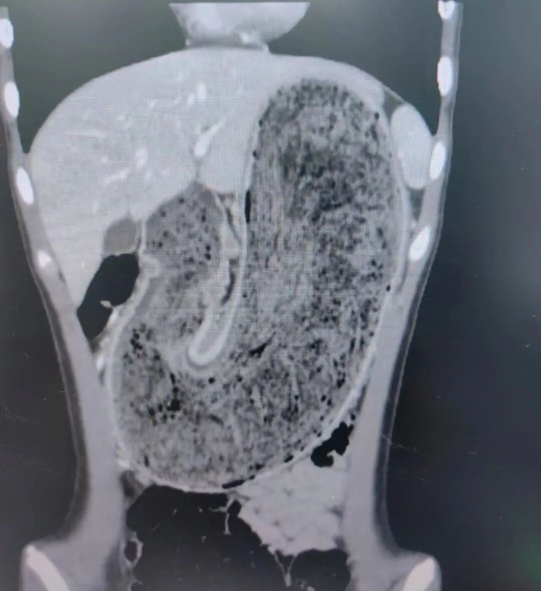 确诊!11岁女孩患上“公主病” 确诊!11岁女孩患上“公主病”