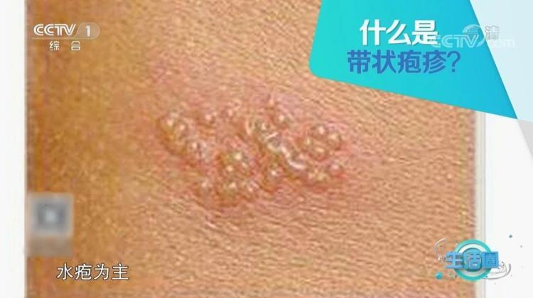 出现“缠腰龙”该如何应对？夏季高发！警惕是这种病