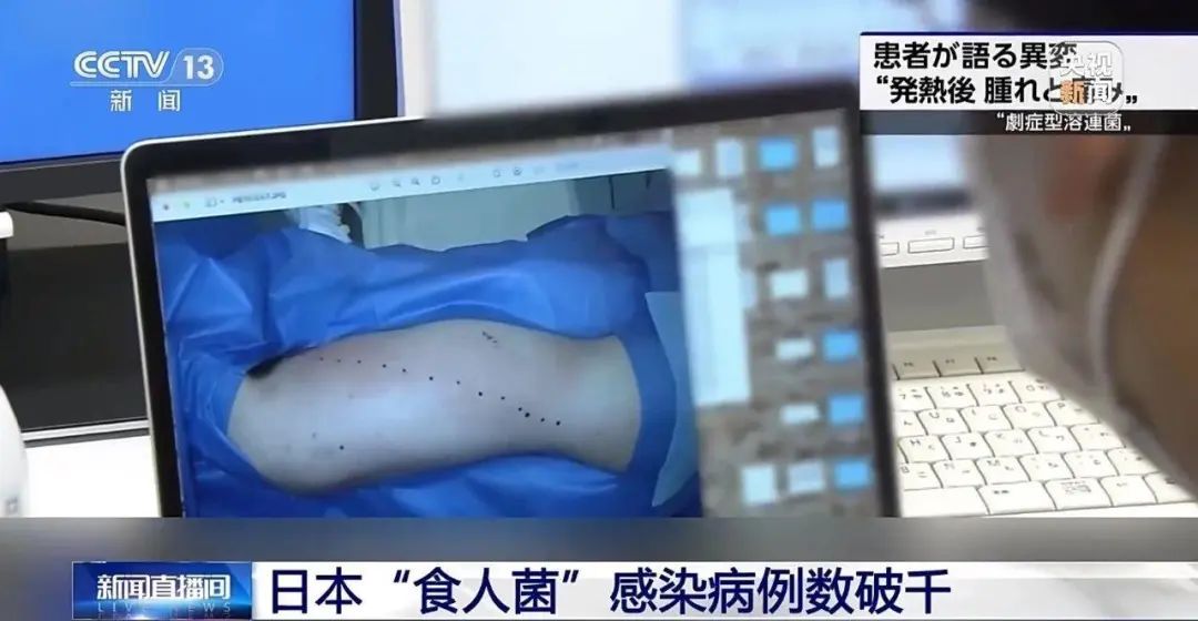 致死率30%！日本已有1144例食人菌感染病例，这两类人群注意→