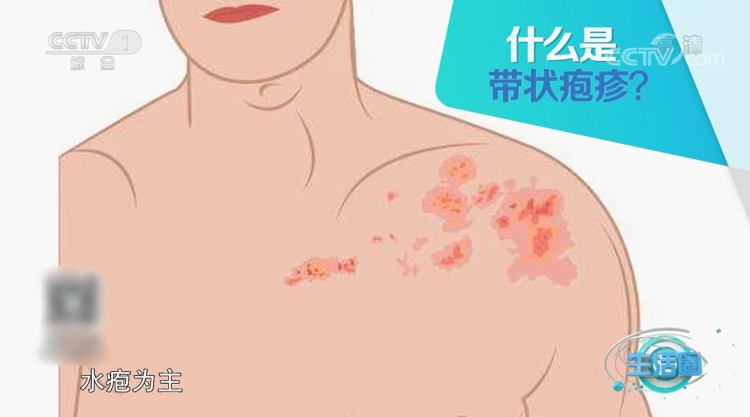 出现“缠腰龙”该如何应对？夏季高发！警惕是这种病