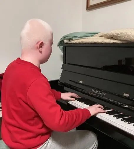 得用望远镜看黑板的白化病男孩688分被清华录取,专业是→ 得用望远镜看黑板的白化病男孩688分被清华录取,专业是→