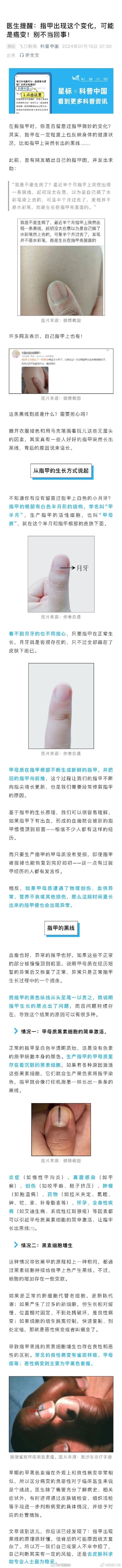 指甲突然出现黑线可能是癌变