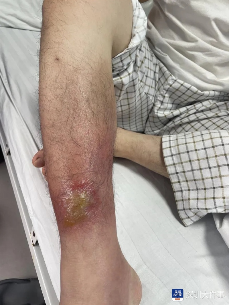 当心！夏天做这事，小伙腿“烂”到直流脓！医生提醒