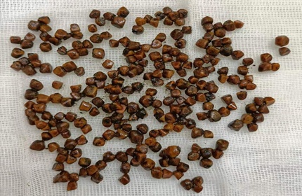 如不切除胆囊则可能导致胆囊炎,胰腺炎反复发作,甚至诱发胆囊癌