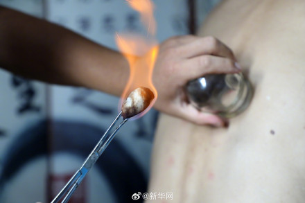 “三伏天”,这些疾病适合“冬病夏治” “三伏天”,这些疾病适合“冬病夏治”