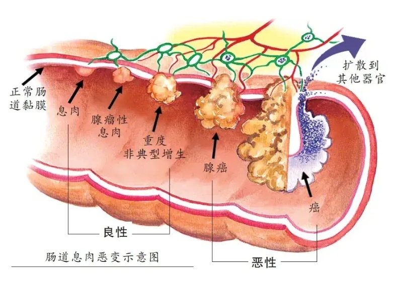 浙江一家8口确诊同种病，一人患癌！医生：遗传性极强，若不干预35岁前很有可能……