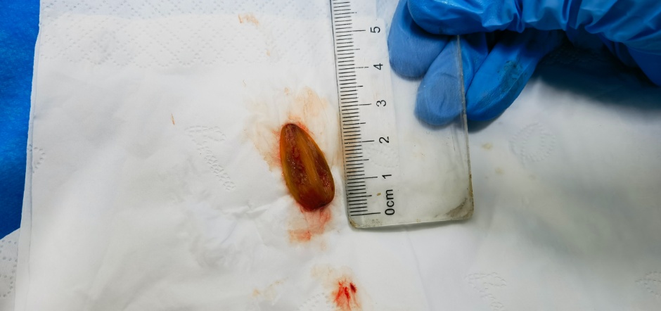 高度疑似肺癌?原来是误食了瓜子壳……呼吸内镜技术成功救治气道异物梗阻患者 高度疑似肺癌?原来是误食了瓜子壳……呼吸内镜技术成功救治气道异物梗阻患者