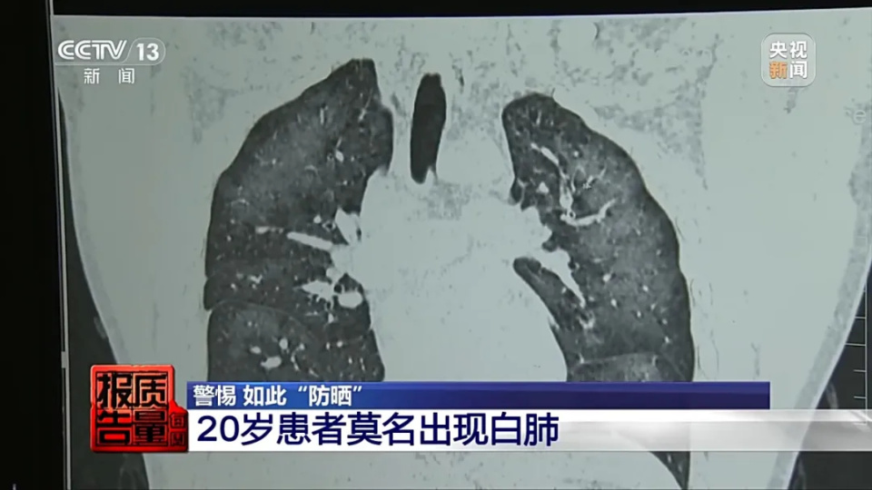 防晒喷雾使用不当,1小时可致“白肺”!医生提醒 防晒喷雾使用不当,1小时可致“白肺”!医生提醒