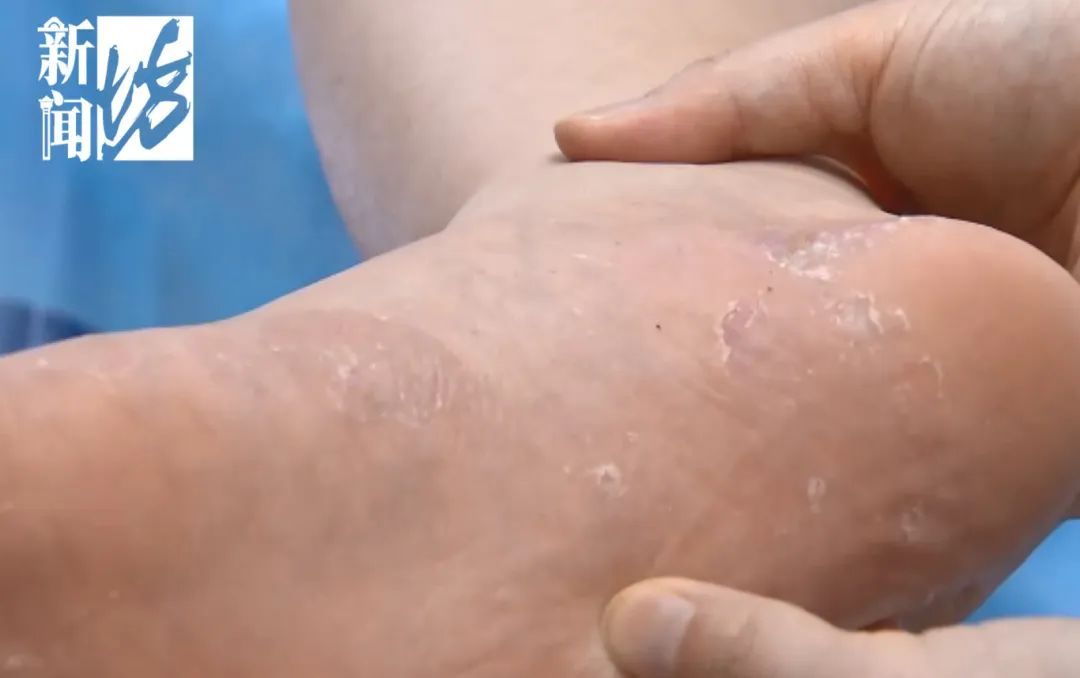 很多上海人有这种难言之隐！最近卷土重来？专家提醒：这种情况别混淆→