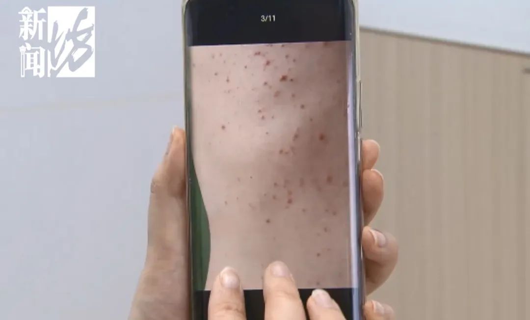 很多上海人有这种难言之隐！最近卷土重来？专家提醒：这种情况别混淆→