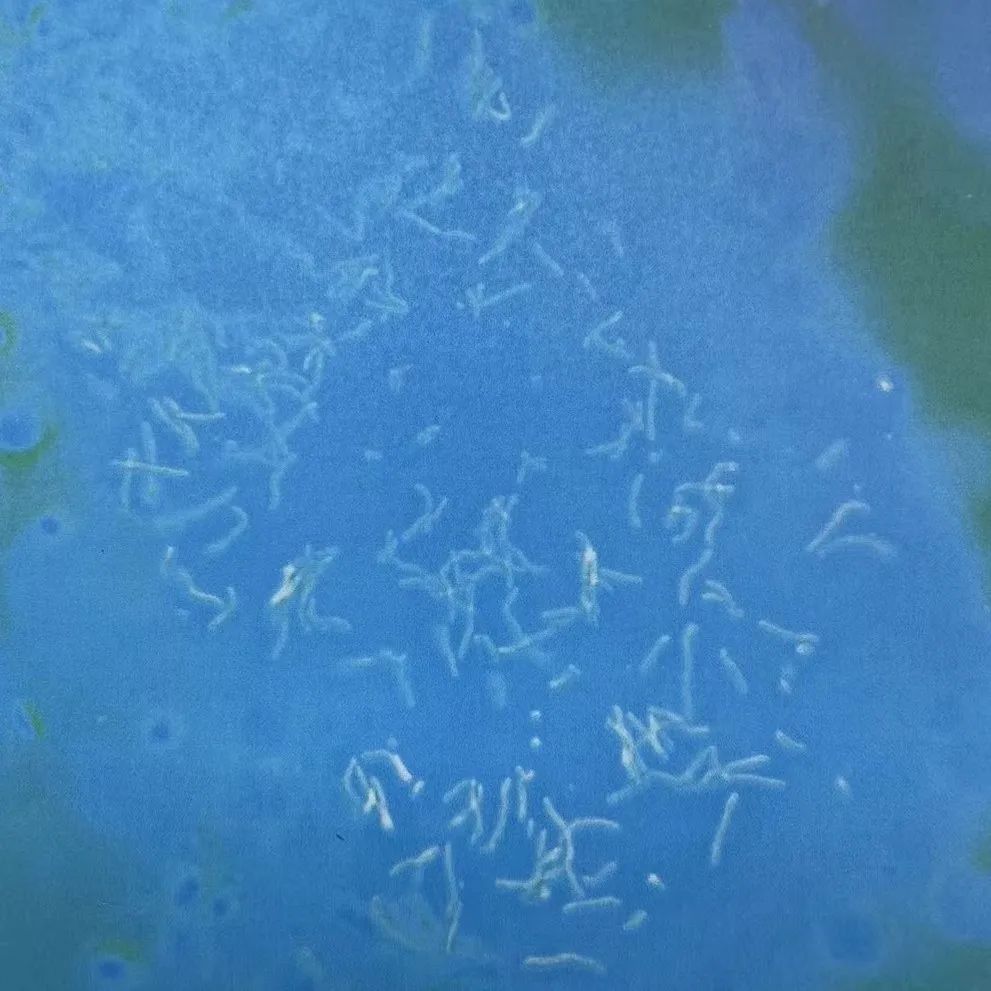 夏日出汗多,皮肤“花斑”需警惕 夏日出汗多,皮肤“花斑”需警惕