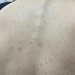 夏日出汗多,皮肤“花斑”需警惕 夏日出汗多,皮肤“花斑”需警惕