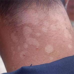 夏日出汗多,皮肤“花斑”需警惕 夏日出汗多,皮肤“花斑”需警惕