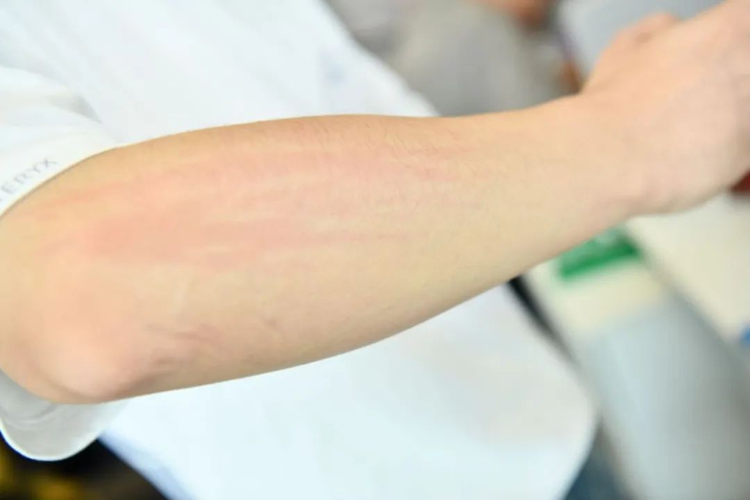 怎样处理伤口才能不留疤？皮肤科医生教你几招