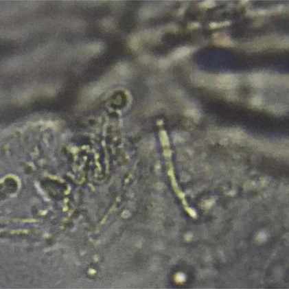 夏日出汗多,皮肤“花斑”需警惕 夏日出汗多,皮肤“花斑”需警惕