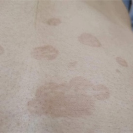 夏日出汗多,皮肤“花斑”需警惕 夏日出汗多,皮肤“花斑”需警惕