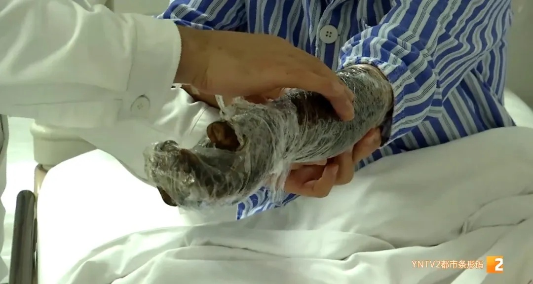 近期患者数量攀升，云南已有近200例！医生紧急提醒……