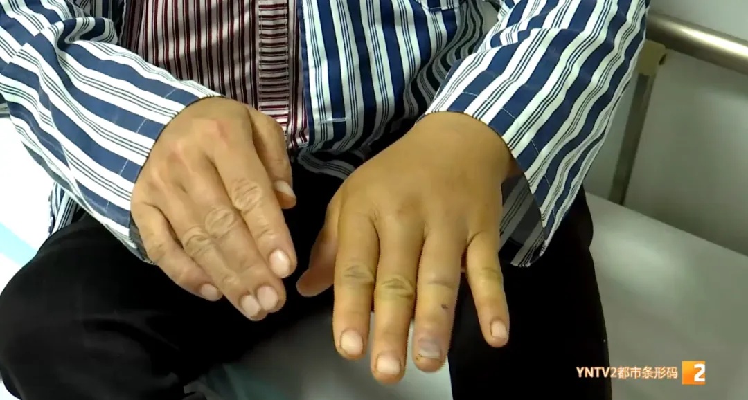 近期患者数量攀升，云南已有近200例！医生紧急提醒……