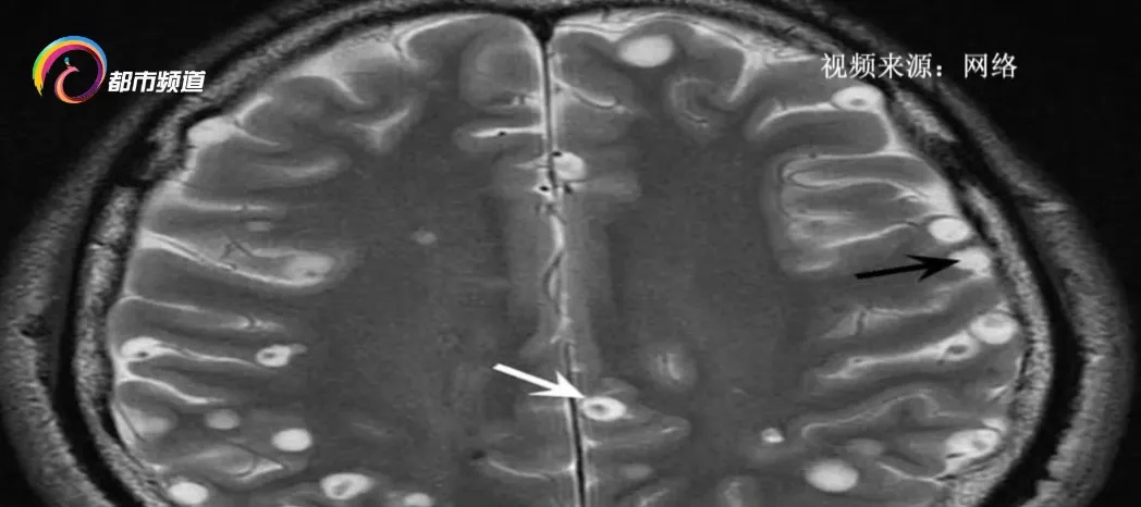 男子头痛,检查发现脑里有一圈一圈的东西!真相细思极恐,很多人爱吃…… 男子头痛,检查发现脑里有一圈一圈的东西!真相细思极恐,很多人爱吃……