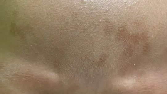 一哭闹就变红的额头小褐斑是什么? 一哭闹就变红的额头小褐斑是什么?