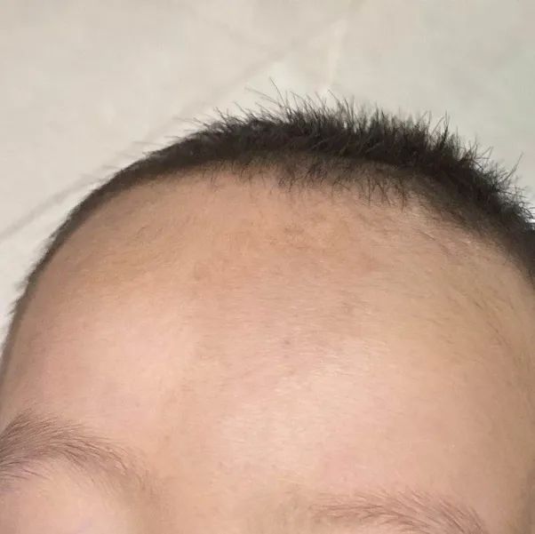 一哭闹就变红的额头小褐斑是什么? 一哭闹就变红的额头小褐斑是什么?