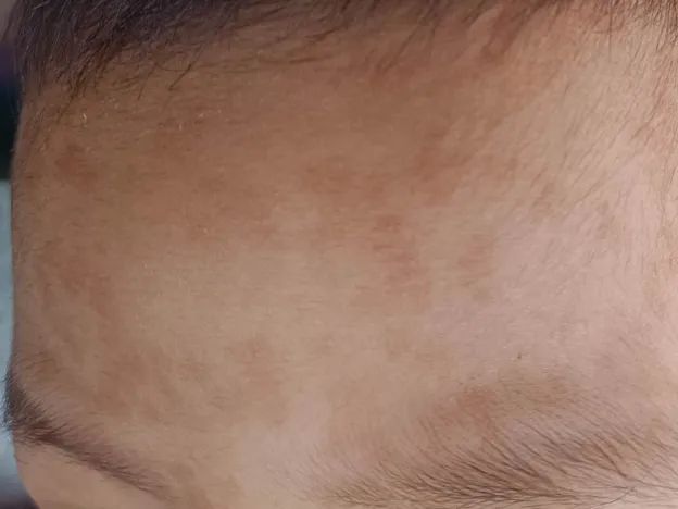 一哭闹就变红的额头小褐斑是什么? 一哭闹就变红的额头小褐斑是什么?