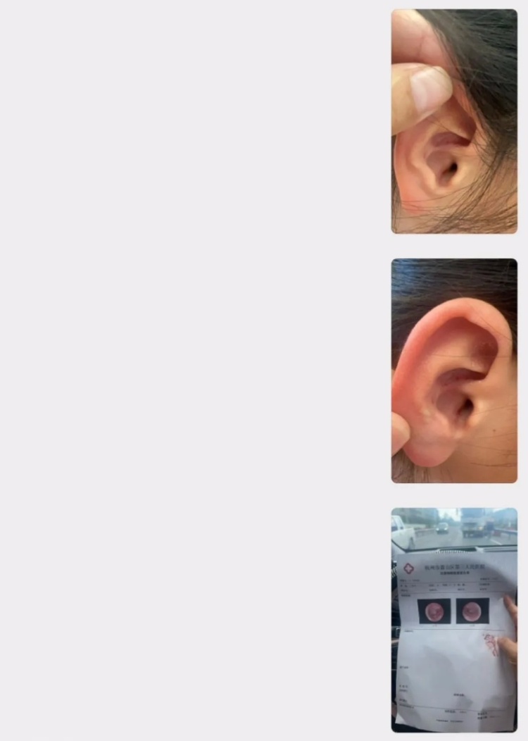 去了趟水上乐园,脸上长满“小肉粒”!两娃回来都中招 去了趟水上乐园,脸上长满“小肉粒”!两娃回来都中招