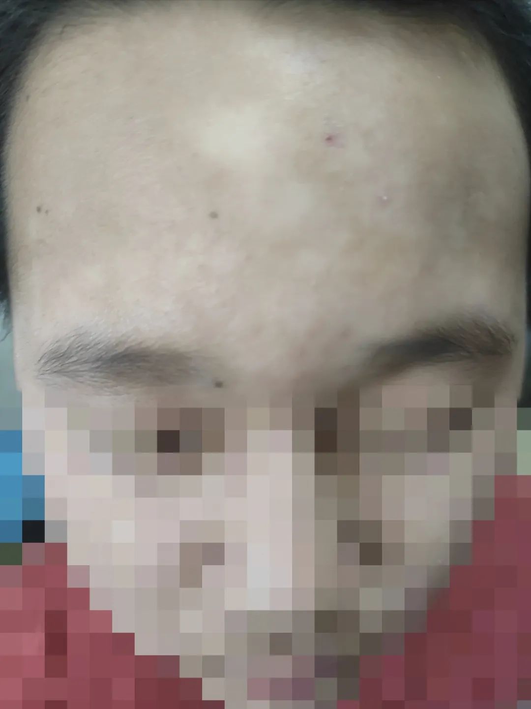 12岁男孩“脚气”长到脸上！当心！这个细节很多人会忽略……