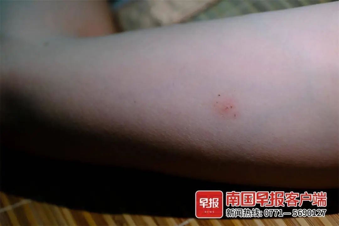头皮发麻!南宁一男子被红火蚁咬伤多处,水泥墙也被啃食…… 头皮发麻!南宁一男子被红火蚁咬伤多处,水泥墙也被啃食……