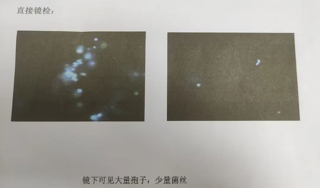 12岁男孩“脚气”长到脸上！当心！这个细节很多人会忽略……