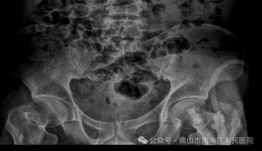 触目惊心!32岁小伙剧烈腹痛,膀胱竟掏出3斤结石,49块“鹅卵石”大…… 触目惊心!32岁小伙剧烈腹痛,膀胱竟掏出3斤结石,49块“鹅卵石”大……