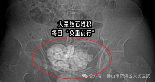 触目惊心!32岁小伙剧烈腹痛,膀胱竟掏出3斤结石,49块“鹅卵石”大…… 触目惊心!32岁小伙剧烈腹痛,膀胱竟掏出3斤结石,49块“鹅卵石”大……