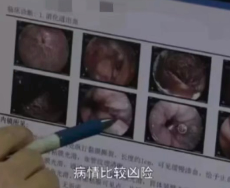 一瓶下肚，男子大口吐血！夏天不少人会犯...