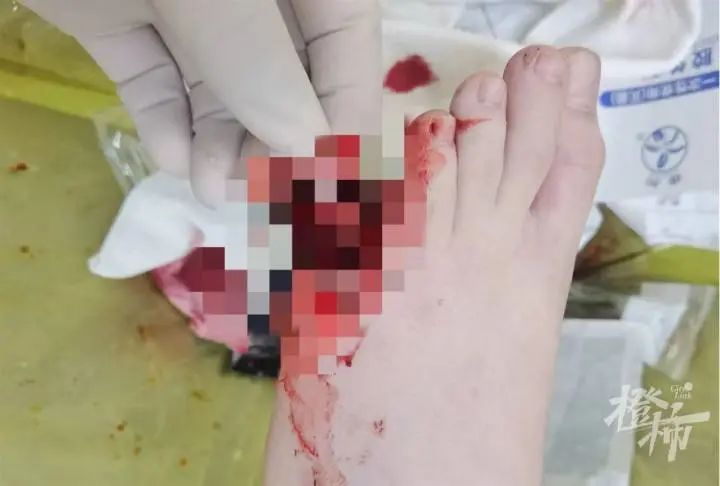 又是它!8岁男孩脚趾被夹断,曾有多人“中招” 又是它!8岁男孩脚趾被夹断,曾有多人“中招”