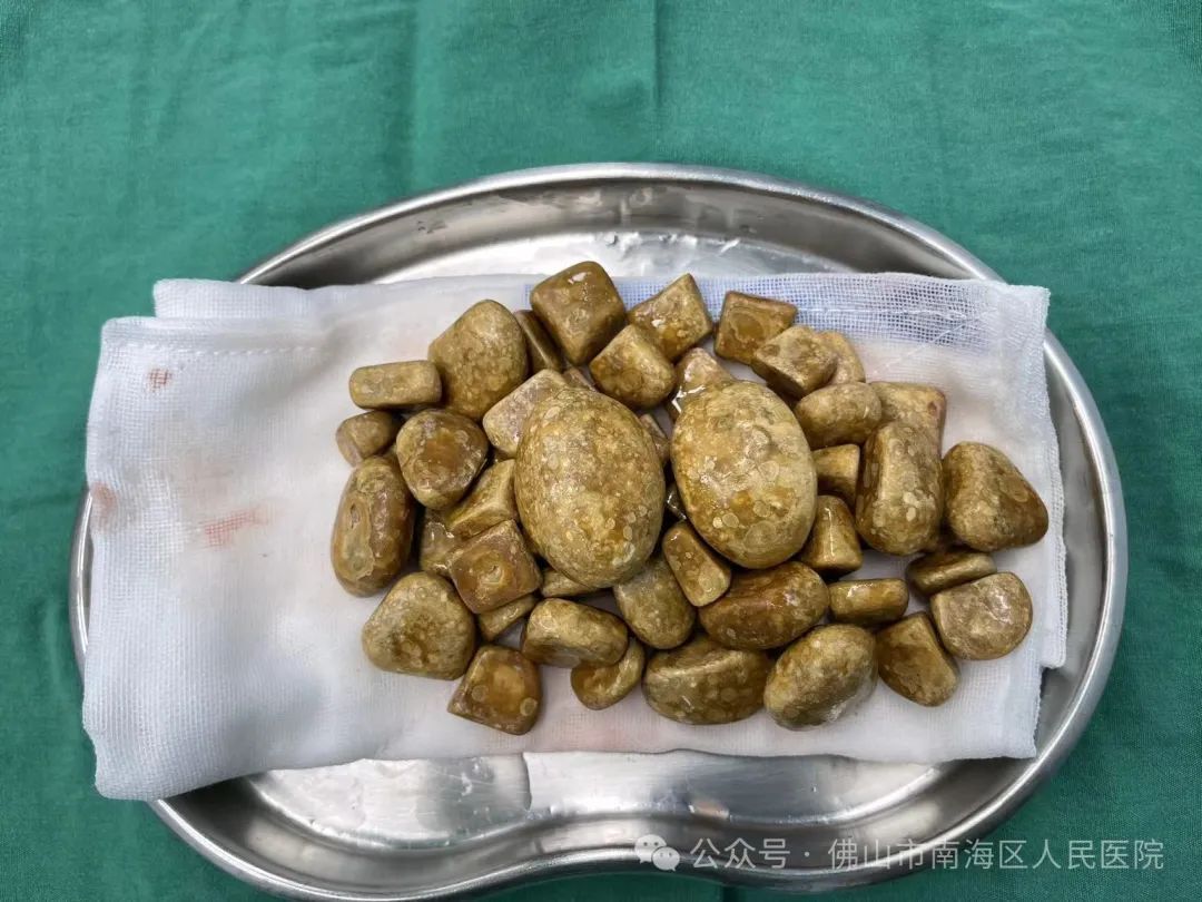 触目惊心!32岁小伙剧烈腹痛,膀胱竟掏出3斤结石,49块“鹅卵石”大…… 触目惊心!32岁小伙剧烈腹痛,膀胱竟掏出3斤结石,49块“鹅卵石”大……