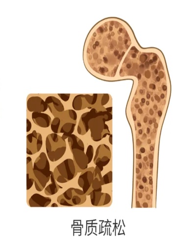 惊！肠道微生物还会影响骨骼健康！