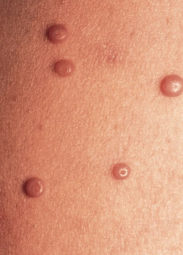 出血昏迷,7岁女孩急入ICU!有儿童甚至死亡,警惕! 出血昏迷,7岁女孩急入ICU!有儿童甚至死亡,警惕!