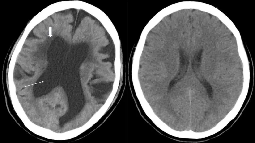 公共卫生论与谈&middot;健康科普｜带你认识老年人正压性脑积水