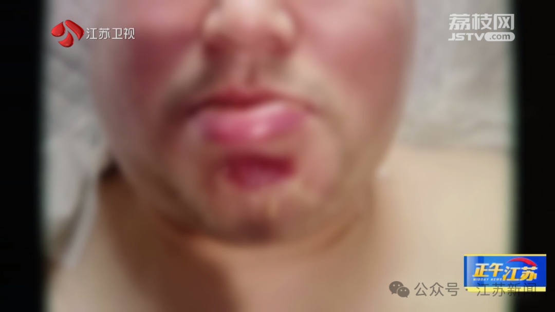 男子在医院做个颈椎手术，为何下巴竟然差点被捅穿了？