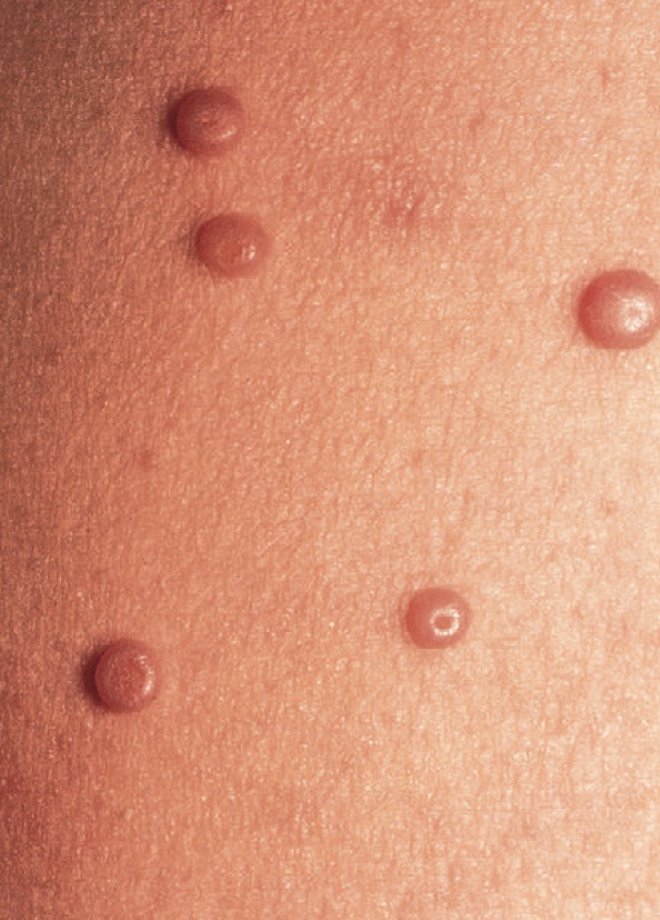 啥情况？去了趟水上乐园，脸上长满“小肉粒”...医生提醒→