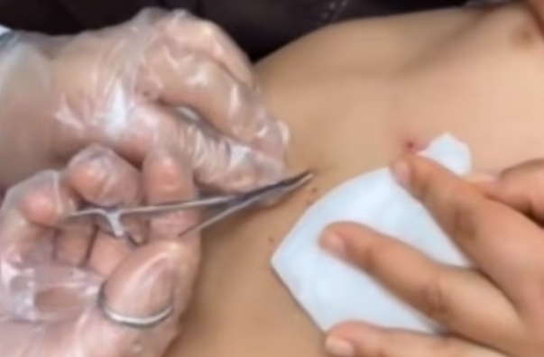 啥情况？去了趟水上乐园，脸上长满“小肉粒”...医生提醒→