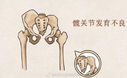发现宝宝双腿皮纹不对称，要警惕发育性髋关节发育不良