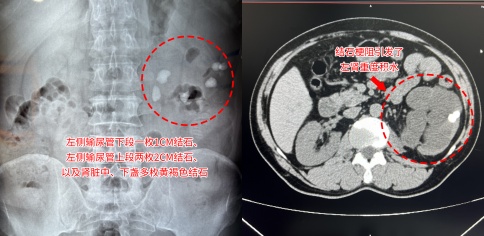养病如养虎，结石久拖不治险毁肾