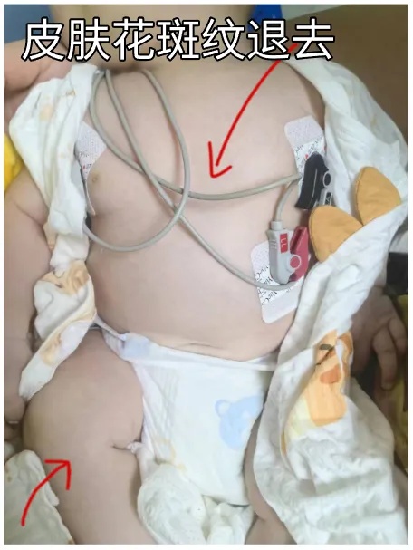 2个月婴儿被抹酒精退烧后休克，医生紧急提醒！