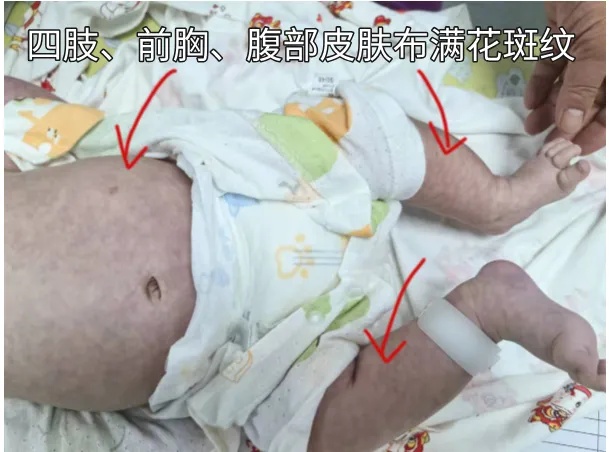 2个月婴儿被抹酒精退烧后休克，医生紧急提醒！