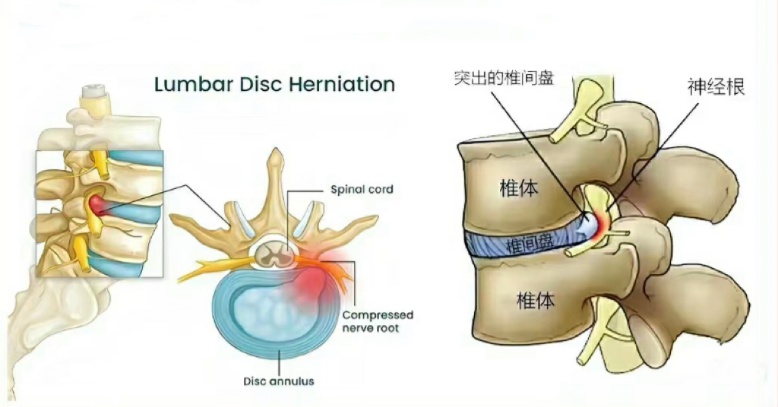 遗传+不良习惯,你的腰椎间盘突出了吗? 遗传+不良习惯,你的腰椎间盘突出了吗?