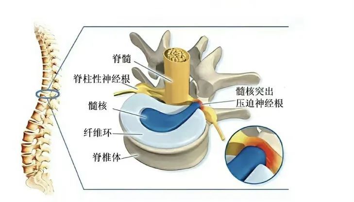 遗传+不良习惯,你的腰椎间盘突出了吗? 遗传+不良习惯,你的腰椎间盘突出了吗?