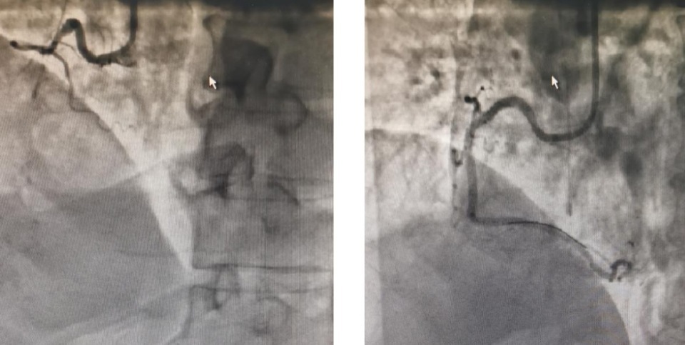 癌症患者突发心梗，多学科合作排除险情……专家提醒，这类高危人群需注意管理