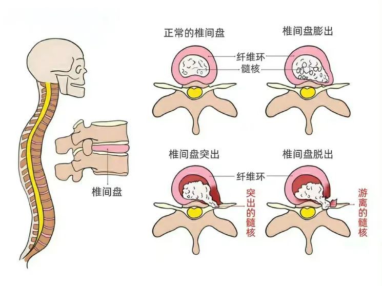 遗传+不良习惯,你的腰椎间盘突出了吗? 遗传+不良习惯,你的腰椎间盘突出了吗?